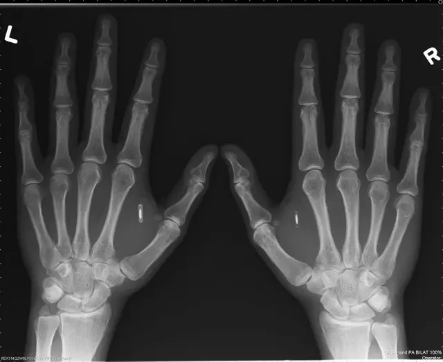 Matéria do Mobile Time sobre chips para implantes corporais